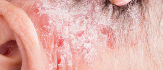 psoriasis
