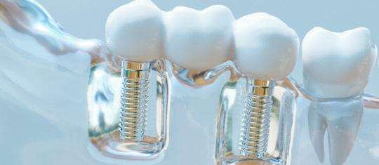 Implants dentaires